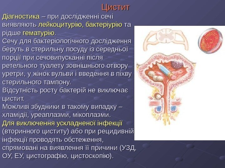   ЦЦ истит Діагностика – при дослідженні сечі виявляють лейкоцитурію, бактеріурію та та